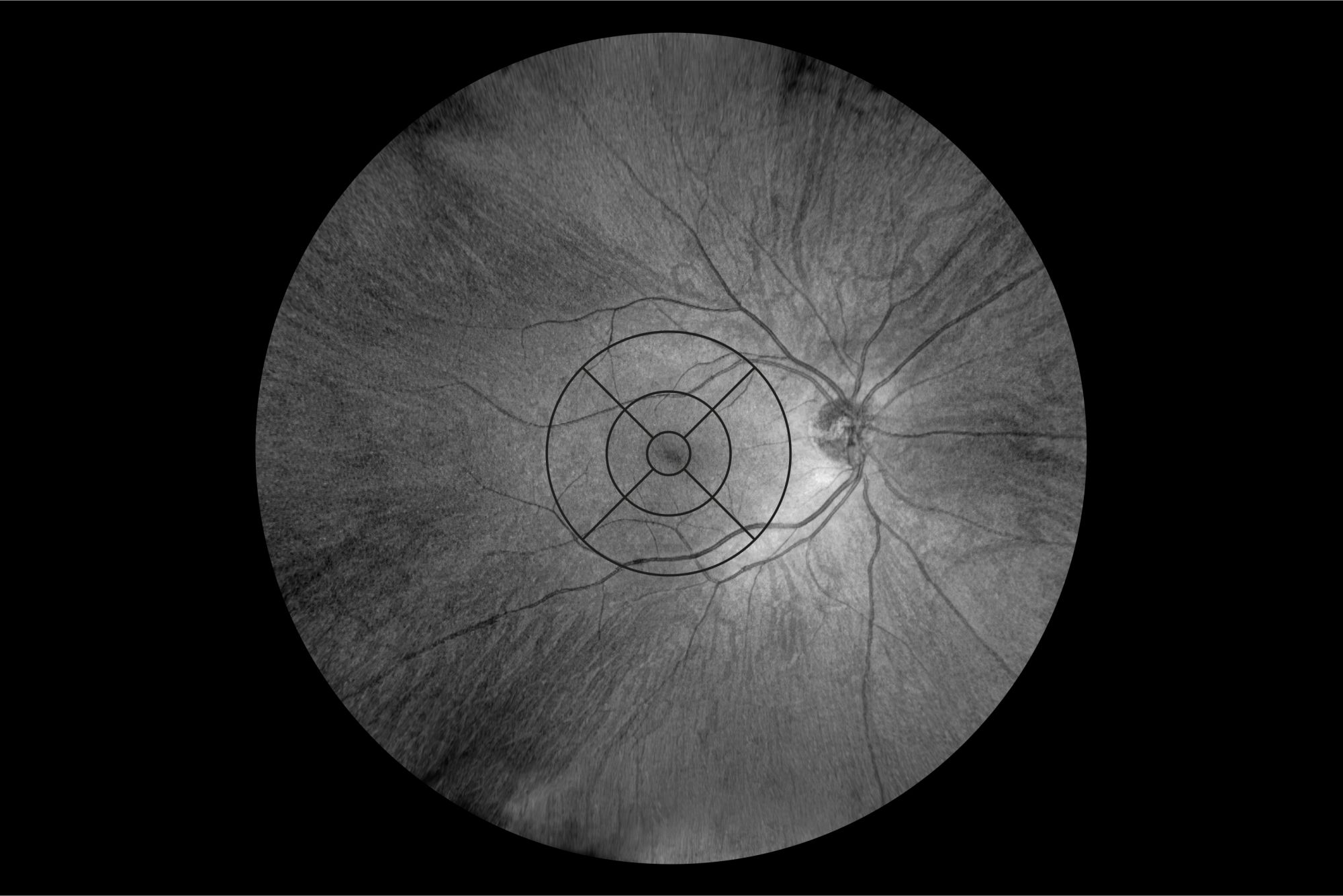 En este momento estás viendo Ultra-Widefield Retinal Optical Coherence Tomography (OCT) and Angio-OCT Using an Add-On Lens